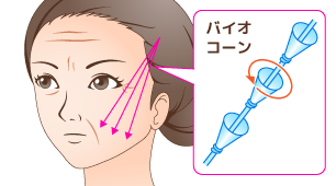 シルエットリフト